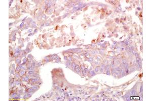 Formalin-fixed and paraffin embedded human lung carcinoma labeled with Anti-MAS1L Polyclonal Antibody, Unconjugated (ABIN759926) at 1:200 followed by conjugation to the secondary antibody and DAB staining. (MAS1L Antikörper  (AA 201-300))