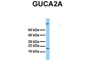 Host:  Rabbit  Target Name:  GUCA2A  Sample Tissue:  Human Stomach Tumor  Antibody Dilution:  1. (GUCA2A Antikörper  (Middle Region))