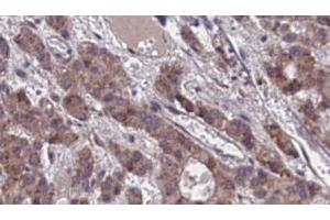 ABIN6273873 at 1/100 staining Human liver cancer tissue by IHC-P. (GPR39 Antikörper  (C-Term))