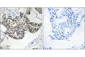 Immunohistochemistry analysis of paraffin-embedded human breast carcinoma tissue, using RSAD1 Antibody. (RSAD1 Antikörper  (AA 298-347))