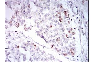 Immunohistochemical analysis of paraffin-embedded ovarian cancer tissues using TERF2 mouse mAb with DAB staining.