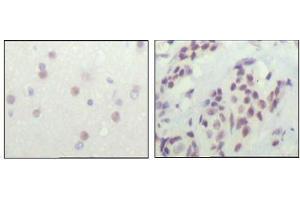 Immunohistochemical analysis of paraffin-embedded human cerebra (left) and breast carcinoma tissue (right), showing nuclear location with DAB staining using NCOR1 antibody. (NCOR1 Antikörper  (AA 1-192))