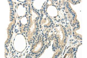 The image on the left is immunohistochemistry of paraffin-embedded Human thyroid cancer tissue using ABIN7193067(WNT6 Antibody) at dilution 1/35, on the right is treated with synthetic peptide.