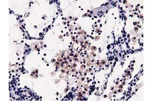 Immunohistochemical staining of paraffin-embedded Carcinoma of Human lung tissue using anti-OSBPL11 mouse monoclonal antibody. (OSBPL11 Antikörper)