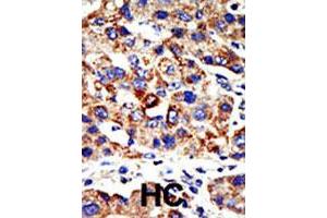 Formalin-fixed and paraffin-embedded human hepatocellular carcinoma tissue reacted with the HDAC8 polyclonal antibody  , which was peroxidase-conjugated to the secondary antibody, followed by AEC staining. (HDAC8 Antikörper  (N-Term))