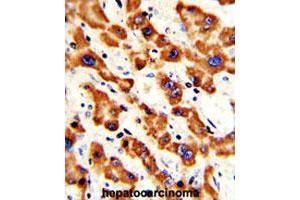 Formalin-fixed and paraffin-embedded human hepatocarcinomareacted with PHB polyclonal antibody , which was peroxidase-conjugated to the secondary antibody, followed by AEC staining. (Prohibitin Antikörper  (AA 99-129))