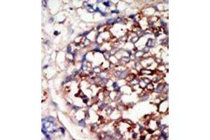 Formalin-fixed and paraffin-embedded human cancer tissue reacted with the primary antibody, which was peroxidase-conjugated to the secondary antibody, followed by DAB staining. (DYRK1B Antikörper  (C-Term))