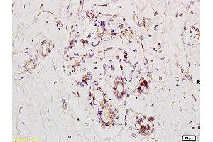 Formalin-fixed and paraffin embedded human breast carcinoma labeled with Anti RNF31/HOIP Polyclonal Antibody, Unconjugated (ABIN1387804) at 1:200 followed by conjugation to the secondary antibody and DAB staining. (RNF31 Antikörper)