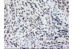 Immunohistochemical staining of paraffin-embedded Adenocarcinoma of Human breast tissue using anti-MGLL mouse monoclonal antibody. (MGLL Antikörper)