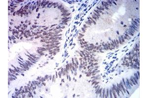 Immunohistochemical analysis of paraffin-embedded rectum cancer tissues using MSH2 mouse mAb with DAB staining. (MSH2 Antikörper  (AA 442-586))