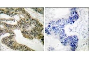 Immunohistochemistry analysis of paraffin-embedded human colon carcinoma tissue, using APC Antibody. (APC Antikörper  (AA 2794-2843))
