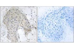 Immunohistochemistry analysis of paraffin-embedded human breast carcinoma tissue, using PPP1R2 (Ab-120/121) Antibody. (PPP1R2 Antikörper  (AA 86-135))