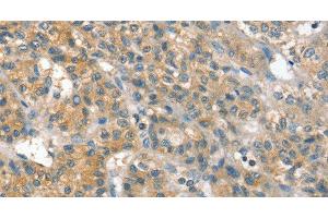 Immunohistochemistry of paraffin-embedded Human liver cancer using PPP2CA Polyclonal Antibody at dilution of 1:35 (PPP2CA Antikörper)