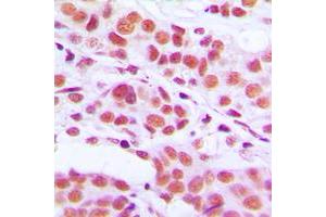 Immunohistochemical analysis of Histone H3 (pS10) staining in human breast cancer formalin fixed paraffin embedded tissue section.