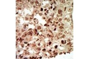 Formalin-fixed and paraffin-embedded human cancer tissue reacted with the primary antibody, which was peroxidase-conjugated to the secondary antibody, followed by AEC staining. (MAPK11 Antikörper  (AA 334-366))