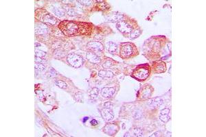 Immunohistochemical analysis of A20 staining in human lung cancer formalin fixed paraffin embedded tissue section. (IGKV1-27 Antikörper  (Center))