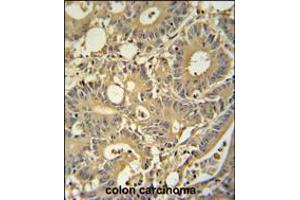 TPSD1 antibody immunohistochemistry analysis in formalin fixed and paraffin embedded human colon carcinoma followed by peroxidase conjugation of the secondary antibody and DAB staining. (TPSD1 Antikörper  (C-Term))