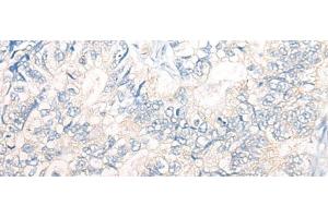 Immunohistochemistry of paraffin-embedded Human gastric cancer tissue using PNPO Polyclonal Antibody at dilution of 1:30(x200) (PNPO Antikörper)
