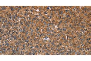 Immunohistochemistry of paraffin-embedded Human lung cancer using GH2 Polyclonal Antibody at dilution of 1:40 (Growth Hormone 2 Antikörper)