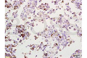 Formalin-fixed and paraffin embedded rat lung melanoma labeled with Anti-MAGE-1 Polyclonal Antibody, Unconjugated (ABIN728578) at 1:200, followed by conjugation to the secondary antibody and DAB staining