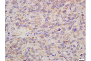 Formalin-fixed and paraffin embedded human liver carcinoma labeled with Rabbit Anti-Hepsin Polyclonal Antibody, Unconjugated (ABIN716816) at 1:200 followed by conjugation to the secondary antibody and DAB staining (Hepsin Antikörper  (AA 311-417))
