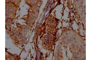 IHC image of ABIN7127408 diluted at 1:100 and staining in paraffin-embedded human endometrial cancer performed on a Leica BondTM system. (Rekombinanter CD73 Antikörper)