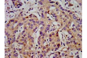 IHC image of ABIN7175596 diluted at 1:500 and staining in paraffin-embedded human liver cancer performed on a Leica BondTM system. (CACNB2 Antikörper  (AA 490-637))