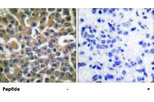 Immunohistochemical analysis of paraffin-embedded human breast carcinoma tissue using EEF2 polyclonal antibody . (EEF2 Antikörper  (Thr56))
