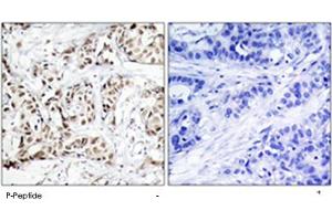 Immunohistochemical analysis of paraffin-embedded human breast carcinoma tissue using MAPK9/MAPK10 (phospho T183) polyclonal antibody . (JNK2 Antikörper  (pThr183))