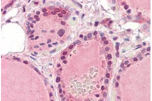 Human Thyroid (formalin-fixed, paraffin-embedded) stained with EPHA2 antibody ABIN364396 at 5 ug/ml followed by biotinylated anti-mouse IgG secondary antibody ABIN481714, alkaline phosphatase-streptavidin and chromogen. (EPH Receptor A2 Antikörper  (AA 559-976))