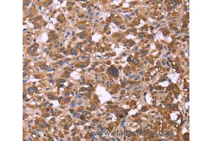 Immunohistochemistry of Human liver cancer using FBXW7 Polyclonal Antibody at dilution of 1:30 (FBXW7 Antikörper)