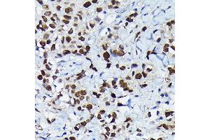 Immunohistochemistry of paraffin-embedded human breast cancer using C/EBPB Rabbit pAb (ABIN6134025, ABIN6138382, ABIN6138383 and ABIN6213964) at dilution of 1:100 (40x lens). (CEBPB Antikörper  (AA 150-250))