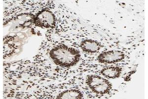 ABIN6266629 at 1/100 staining human colon carcinoma tissue sections by IHC-P.