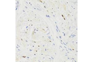 Immunohistochemistry of paraffin-embedded human breast cancer using GEMIN2 Antibody (ABIN1872798) at dilution of 1:100 (40x lens). (SIP1 Antikörper)