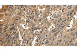 Immunohistochemistry of paraffin-embedded Human ovarian cancer using GSR Polyclonal Antibody at dilution of 1:50 (Glutathione Reductase Antikörper)