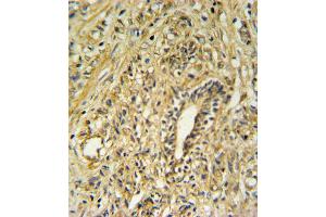 HSD17B2 Antibody IHC analysis in formalin fixed and paraffin embedded human prostate carcinoma followed by peroxidase conjugation of the secondary antibody and DAB staining.