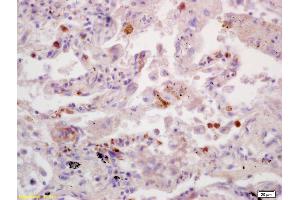Formalin-fixed and paraffin embedded human lung carcinoma labeled with Anti-SDHB Polyclonal Antibody, Unconjugated (ABIN719411) at 1:200 followed by conjugation to the secondary antibody and DAB staining. (SDHB Antikörper  (AA 201-280))