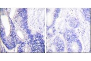 Immunohistochemistry analysis of paraffin-embedded human colon carcinoma tissue, using Claudin 3 Antibody. (Claudin 3 Antikörper  (AA 171-220))