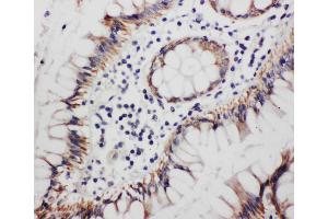 Anti-Progesterone Receptor antibody, IHC(P) IHC(P): Human Rectal Cancer Tissue (Progesterone Receptor Antikörper  (Middle Region))
