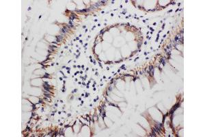 Anti-Progesterone Receptor antibody, IHC(P) IHC(P): Human Rectal Cancer Tissue