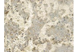 ABIN6261234 and ABIN6272285 at 1/100 staining human melanoma by IHC-P. (DCL1 Antikörper  (Internal Region))