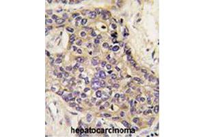 Formalin-fixed and paraffin-embedded human hepatocellular carcinoma reacted with HGF polyclonal antibody  , which was peroxidase-conjugated to the secondary antibody, followed by DAB staining. (HGF Antikörper  (AA 521-554))