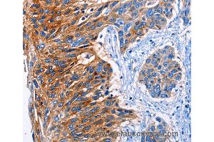 Immunohistochemistry of Human esophagus cancer using CLEC2B Polyclonal Antibody at dilution of 1:50 (CLEC2B Antikörper)