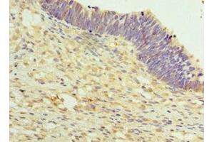 Immunohistochemistry of paraffin-embedded human ovarian cancer using ABIN7159637 at dilution of 1:100 (TET2 Antikörper  (AA 1833-2002))