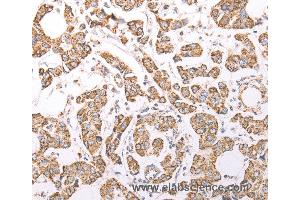 Immunohistochemistry of Human breast cancer using ATPIF1 Polyclonal Antibody at dilution of 1:60 (ATPase Inhibitory Factor 1 Antikörper)