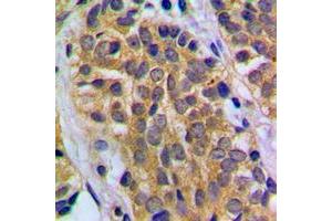 Immunohistochemical analysis of HEXB staining in human prostate cancer formalin fixed paraffin embedded tissue section. (HEXB Antikörper  (C-Term))