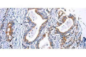 Immunohistochemistry of paraffin-embedded Human gastric cancer using DRD4 Polyclonal Antibody at dilution of 1:30 (DRD4 Antikörper)