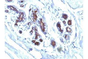 Formalin-fixed, paraffin-embedded human Breast Carcinoma stained with Milk Fat Globule Monoclonal Antibody (EDM45) (MFGE8 Antikörper)
