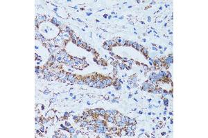 Immunohistochemistry of paraffin-embedded human colon carcinoma using GIP antibody (ABIN1882357) at dilution of 1:100 (40x lens). (GIP Antikörper)