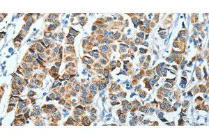 Immunohistochemistry of paraffin-embedded Human breast cancer using ALDH4A1 Polyclonal Antibody at dilution of 1:45 (ALDH4A1 Antikörper)